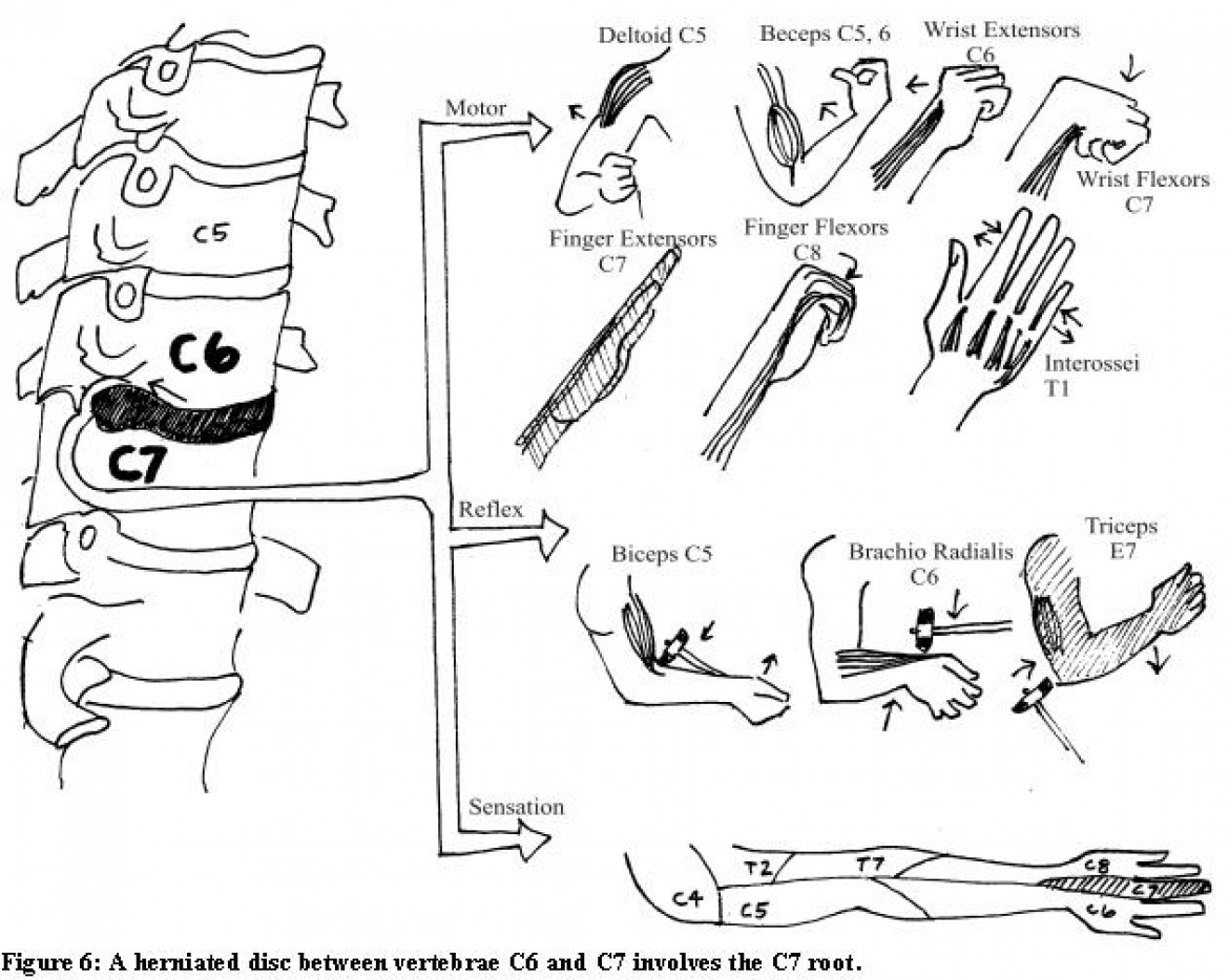 Neck Pain Symptoms which travel down your arm. Osteopath Edinburgh