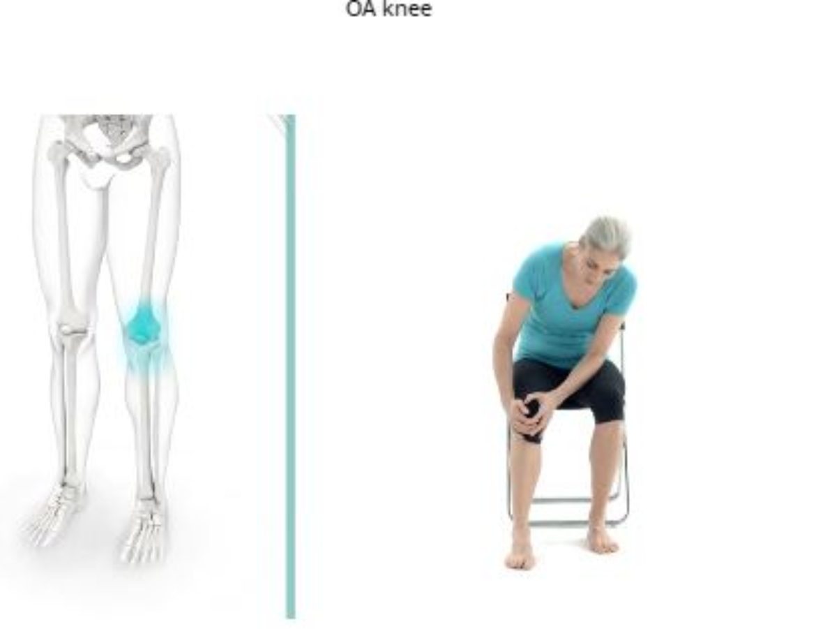 Knee Pain common cause can be Osteoarthritis