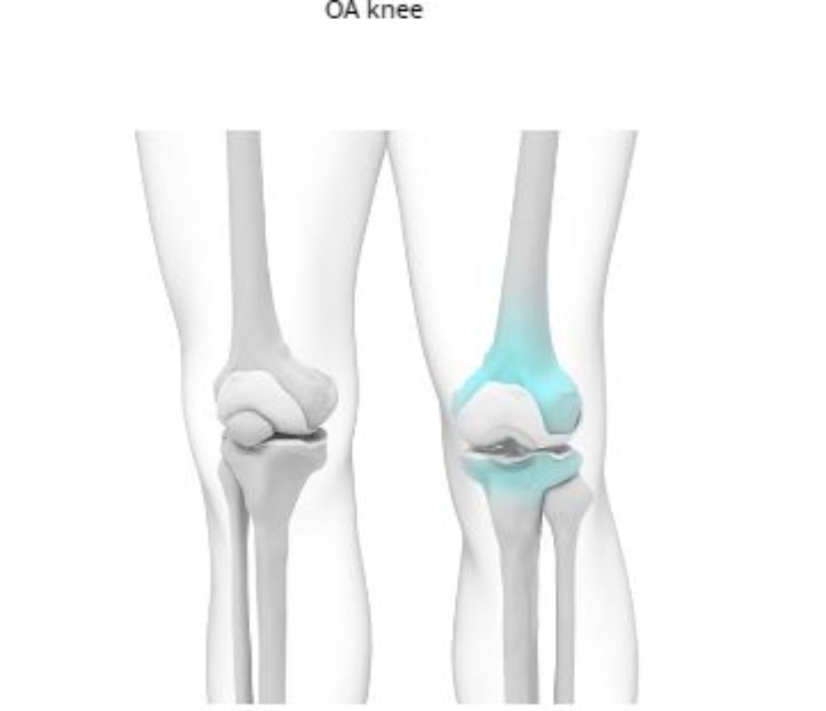 Knee Pain common cause can be Osteoarthritis