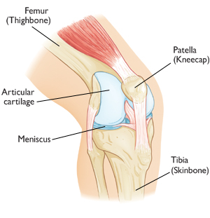 A Knee Injury from Skiing –  Patella Dislocation