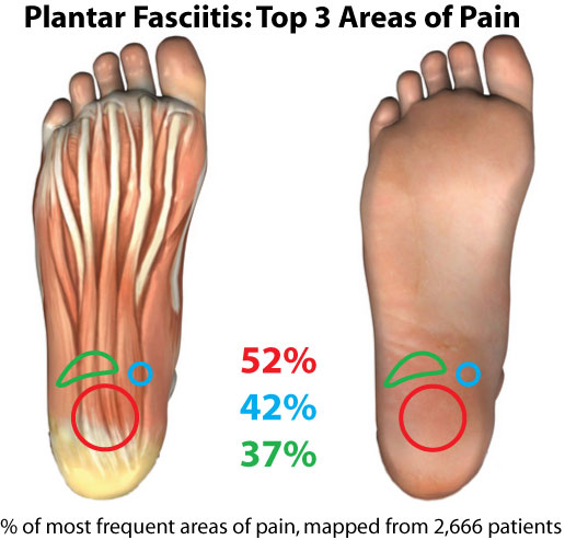 Planter Fasciitis – Heel Pain including Differential Diagnosis   ~Treatments include stretches exercises orthotics  comfy shoes  Shockwave Therapy and or Ultra sound Therapy