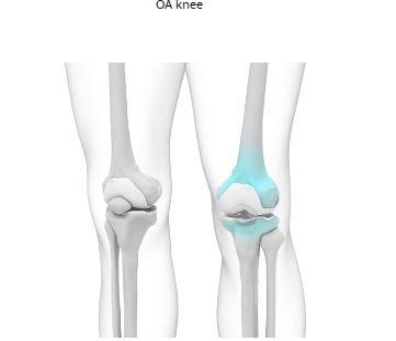 Knee Pain  common cause can be  Osteoarthritis