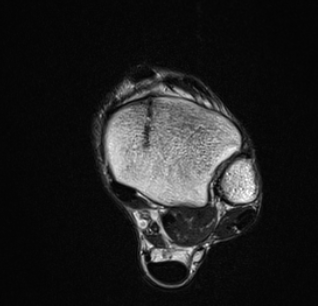 Focus Shockwaves and Lower Limb Stress Fractures