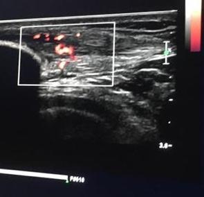 Achilles Tendinopathy  and Patella Tendinopathy