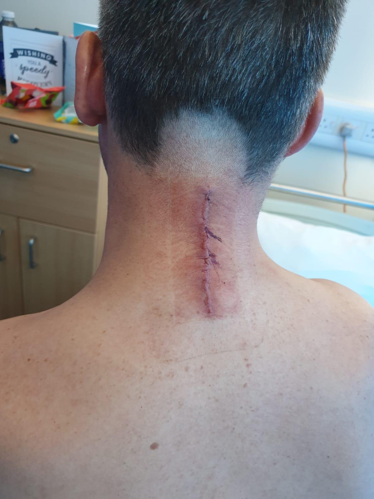 Neck  Pain Surgery and Recovery