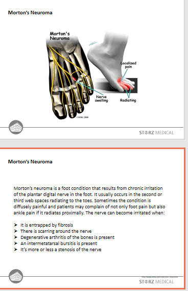 Morton` s Neuroma