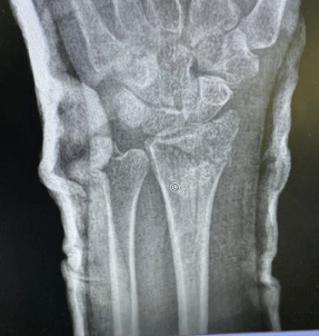 Wrist Pain treated with shockwaves from wrist fracture