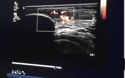 Case History: Severe Patellar Tendinosis, Focused Shockwave