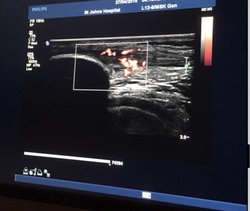 Case History: Severe Patellar Tendinosis, Focused Shockwave