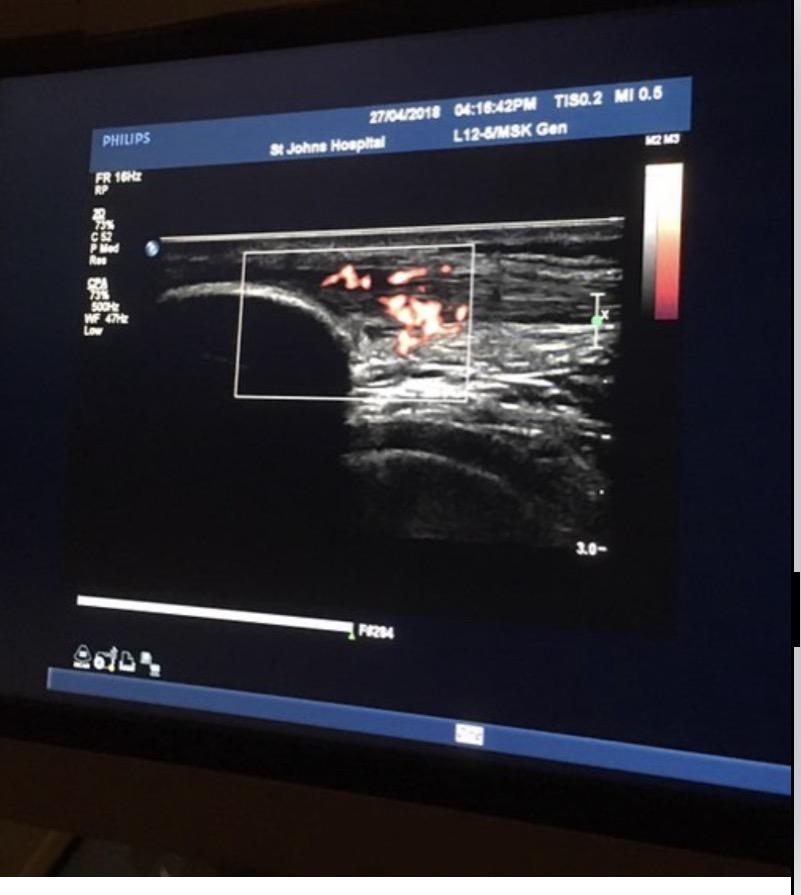 Severe Patella Tendinosis