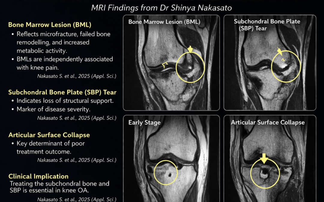 Regenerative Medicine Knee OA
